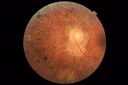 RetinitisPigmentosa_sclee_062518_09.JPG