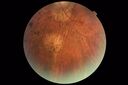 RetinitisPigmentosa_sclee_062518_10.JPG