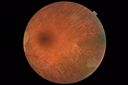 RetinitisPigmentosa_sclee_062518_11.JPG