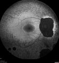 RetinitisPigmentosa_sclee_062518_12.jpg
