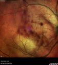 Toxoplasmosis_kedeg_2016_04.jpg