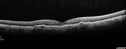 amd_asymptomatic_eiwe_042017_11.jpg