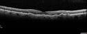 amd_asymptomatic_eiwe_042017_13.jpg