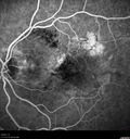amd_asymptomatic_eiwe_042017_15.jpg