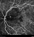 amd_asymptomatic_eiwe_042017_22.jpg