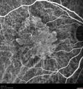 amd_asymptomatic_eiwe_042017_26.jpg