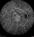 amd_asymptomatic_eiwe_042017_27.jpg