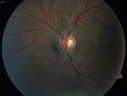 angioidS_miba_051915_04.png