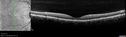 angioidS_miba_051915_14.jpg
