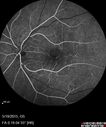 angioidS_miba_051915_20.jpg
