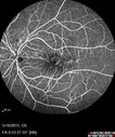 angioidS_miba_051915_23.jpg