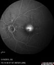 angioidS_miba_051915_26.jpg