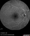 angioidS_miba_051915_29.jpg