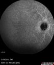 angioidS_miba_051915_37.jpg
