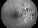 angioidcnam_jasc_281029.jpg