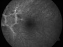 angioidcnam_jasc_281429.jpg
