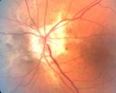 angioidcnam_jasc_28429.jpg