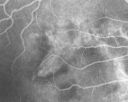 angioidcnam_jasc_28729.jpg