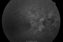 angioidstreakrolo_281329.png