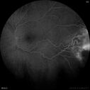 angioma_113458_120522_09.jpg