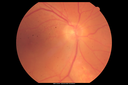 autoimmune-csr_rilo_020915_02.png