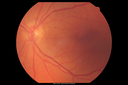 autoimmune-csr_rilo_020915_03.png