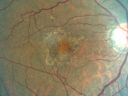 basallaminardrusen_yoar01.jpg
