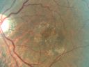 basallaminardrusen_yoar02.jpg