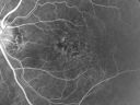 basallaminardrusen_yoar05.jpg
