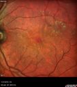 bdr_edema_laser_redas_013119_02.jpg