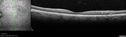 bdr_edema_laser_redas_013119_05.jpg