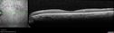 bdr_edema_laser_redas_013119_06.jpg