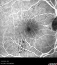 bdr_edema_laser_redas_013119_08.jpg