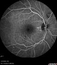 bdr_edema_laser_redas_013119_09.jpg