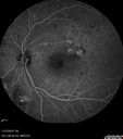 bdr_edema_laser_redas_013119_15.jpg