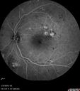 bdr_edema_laser_redas_013119_16.jpg