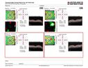 bdr_edema_laser_redas_013119_17.JPG