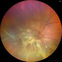 bilateral-total-rd_115955_01.jpg