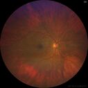 choroidal-macrovessel_116061_01.jpg