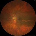 choroidal-macrovessel_116061_02.jpg