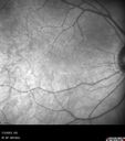 choroidal-macrovessel_116061_04.jpg