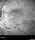 choroidal-macrovessel_116061_05.jpg