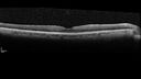 choroidal-macrovessel_116061_06.jpg
