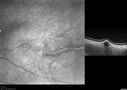 choroidal-macrovessel_116061_08.jpg
