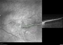 choroidal-macrovessel_116061_09.jpg