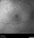 choroidal-macrovessel_116061_10.jpg