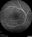 choroidal-macrovessel_116061_12.jpg