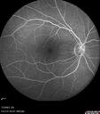 choroidal-macrovessel_116061_13.jpg