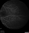 choroidal-macrovessel_116061_15.jpg