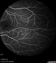 choroidal-macrovessel_116061_16.jpg
